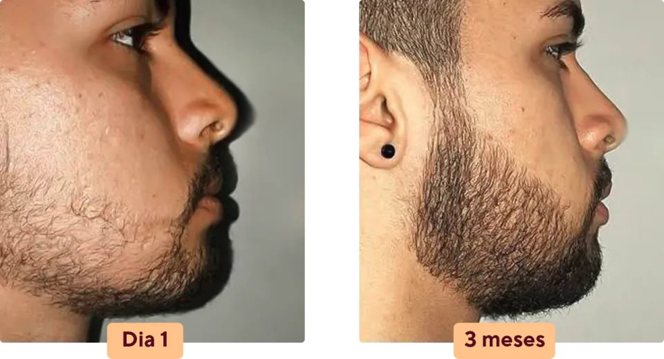 barba negra resultado luiz